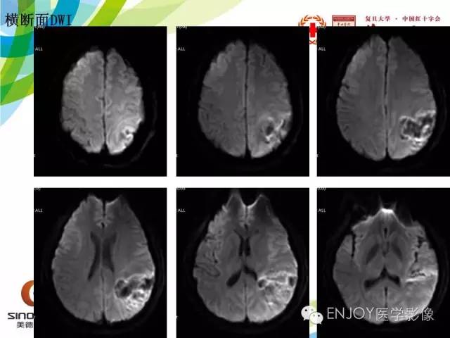 【病例】原发性中枢神经系统血管炎1例MR影像表现