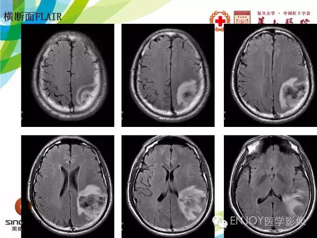 【病例】原发性中枢神经系统血管炎1例MR影像表现