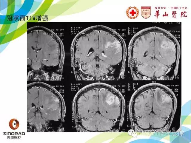 【病例】原发性中枢神经系统血管炎1例MR影像表现