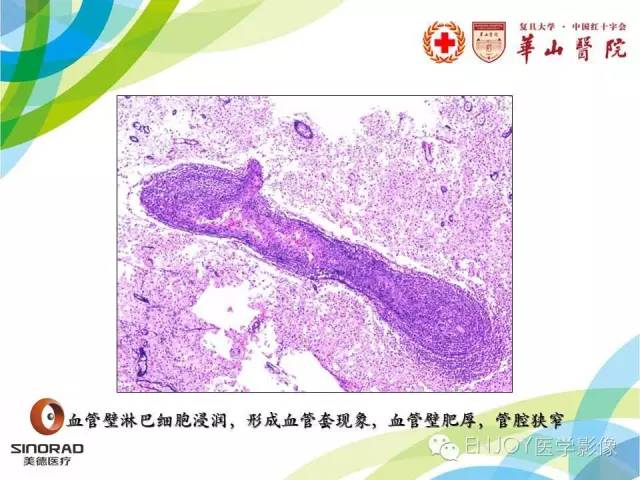【病例】原发性中枢神经系统血管炎1例MR影像表现