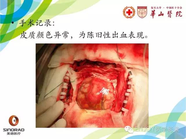 【病例】原发性中枢神经系统血管炎1例MR影像表现