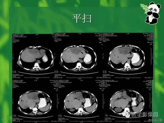 【病例】胆管细胞癌1例CT影像表现