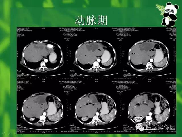 【病例】胆管细胞癌1例CT影像表现 【病例】胆管细胞癌1例CT影像表现