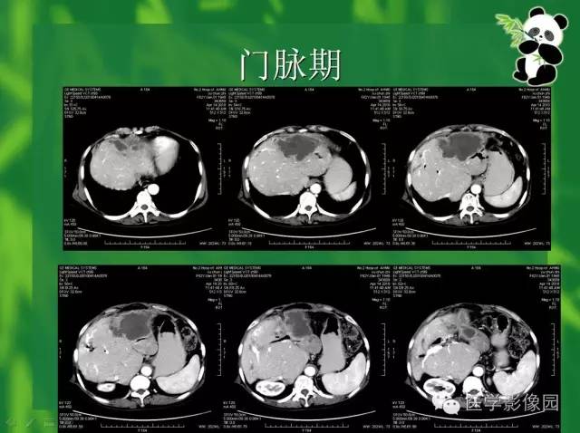 【病例】胆管细胞癌1例CT影像表现 【病例】胆管细胞癌1例CT影像表现