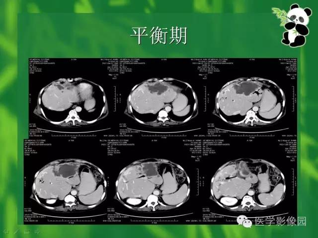 【病例】胆管细胞癌1例CT影像表现 【病例】胆管细胞癌1例CT影像表现