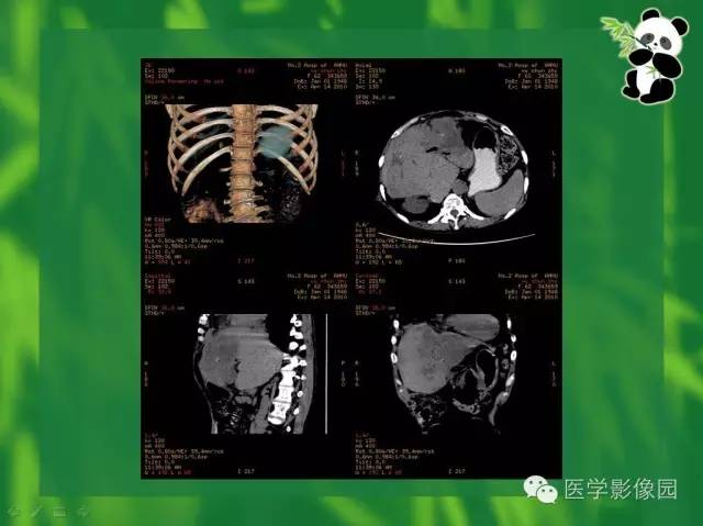 【病例】胆管细胞癌1例CT影像表现 【病例】胆管细胞癌1例CT影像表现