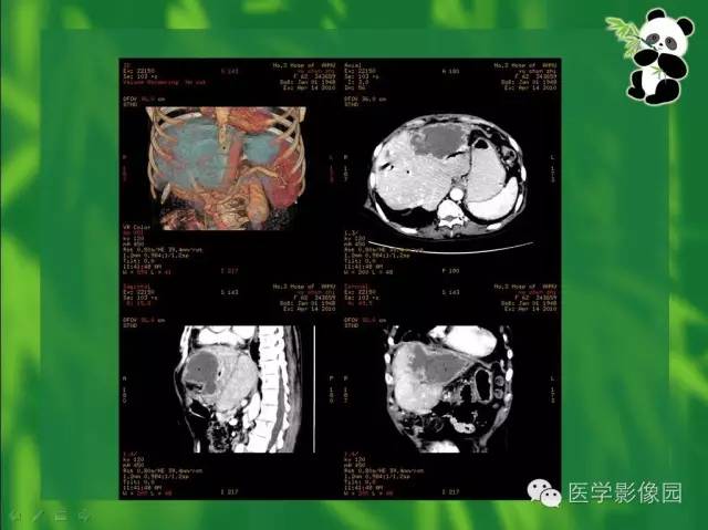 【病例】胆管细胞癌1例CT影像表现 【病例】胆管细胞癌1例CT影像表现