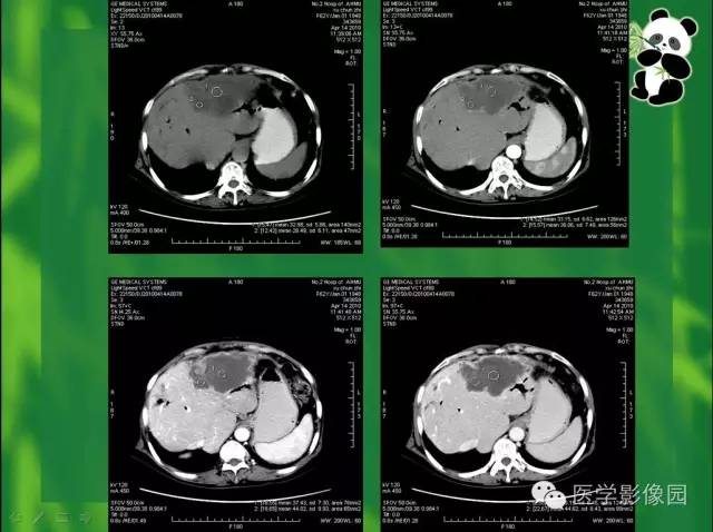 【病例】胆管细胞癌1例CT影像表现 【病例】胆管细胞癌1例CT影像表现