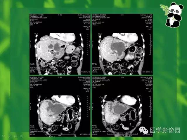 【病例】胆管细胞癌1例CT影像表现 【病例】胆管细胞癌1例CT影像表现
