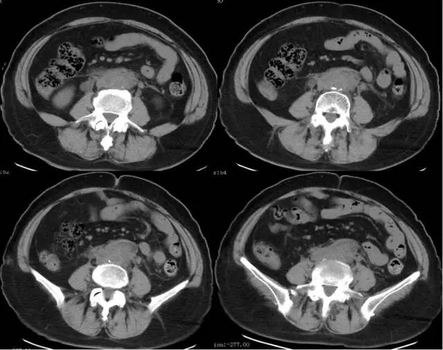 【病例】腹膜后纤维化1例CT影像表现 【病例】腹膜后纤维化1例CT影像表现