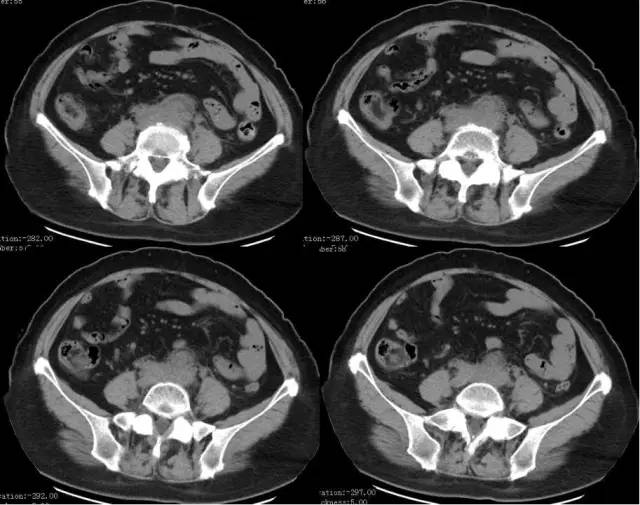 【病例】腹膜后纤维化1例CT影像表现 【病例】腹膜后纤维化1例CT影像表现