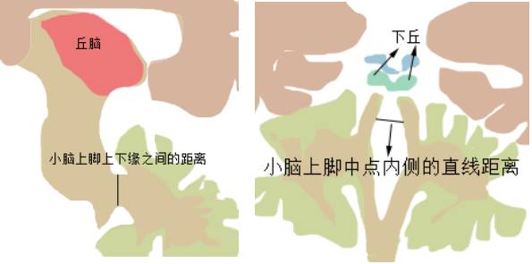 进行性核上性麻痹MRI特点——只知道蜂鸟征? 进行性核上性麻痹MRI特点——只知道蜂鸟征?