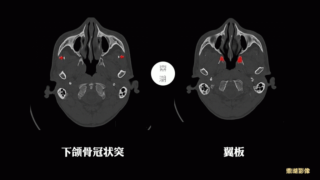 超精致颅底断层解剖