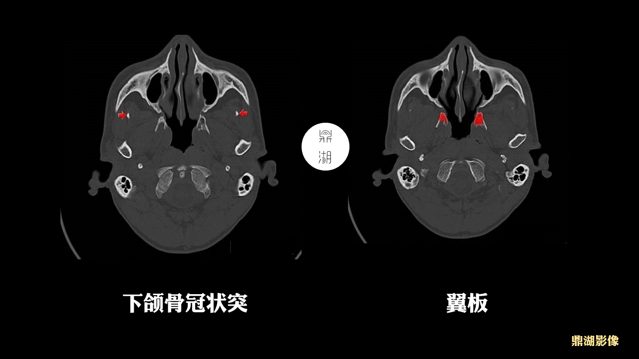 超精致颅底断层解剖