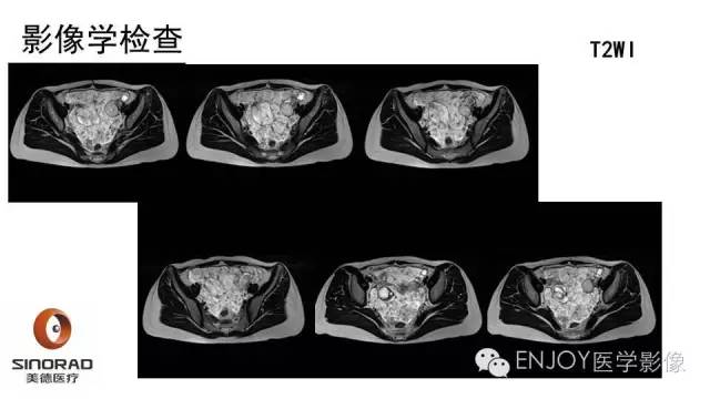 【病例】卵巢交界性浆液性表面乳头状瘤1例MR病例读片
