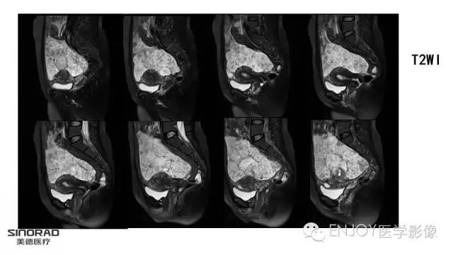 【病例】卵巢交界性浆液性表面乳头状瘤1例MR病例读片