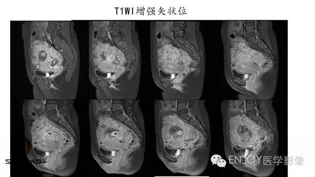 【病例】卵巢交界性浆液性表面乳头状瘤1例MR病例读片