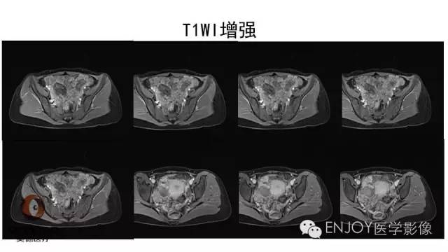 【病例】卵巢交界性浆液性表面乳头状瘤1例MR病例读片