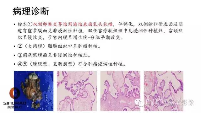 【病例】卵巢交界性浆液性表面乳头状瘤1例MR病例读片