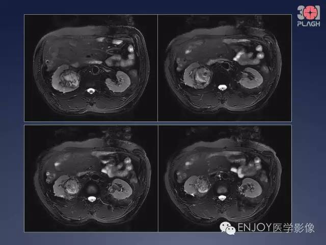 【病例】双肾透明细胞癌1例MR病例读片 【病例】双肾透明细胞癌1例MR病例读片