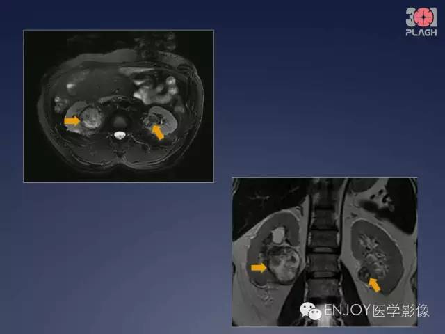 【病例】双肾透明细胞癌1例MR病例读片 【病例】双肾透明细胞癌1例MR病例读片