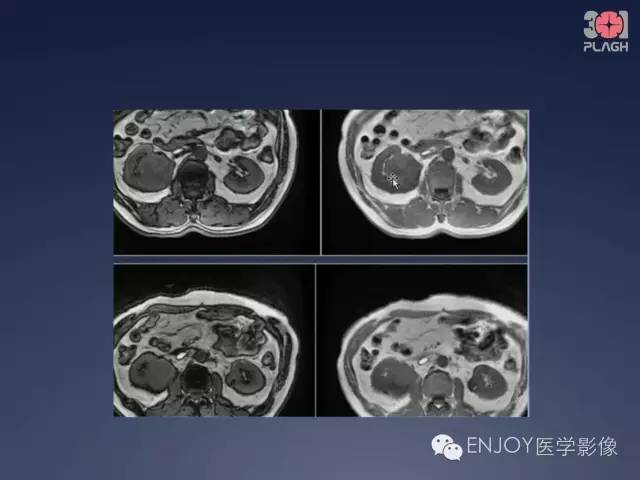 【病例】双肾透明细胞癌1例MR病例读片 【病例】双肾透明细胞癌1例MR病例读片