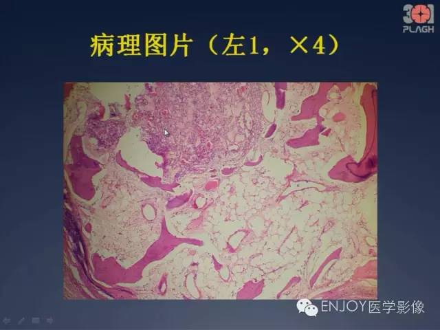 【病例】双肾透明细胞癌1例MR病例读片 【病例】双肾透明细胞癌1例MR病例读片