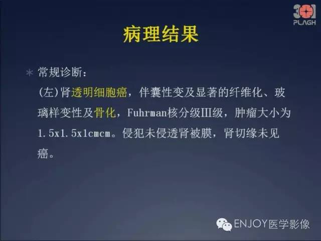 【病例】双肾透明细胞癌1例MR病例读片 【病例】双肾透明细胞癌1例MR病例读片