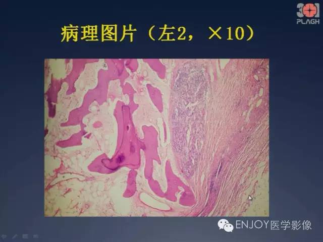 【病例】双肾透明细胞癌1例MR病例读片 【病例】双肾透明细胞癌1例MR病例读片