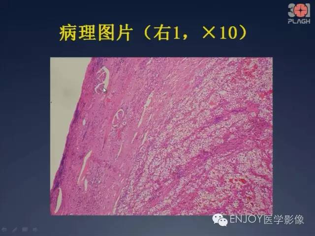 【病例】双肾透明细胞癌1例MR病例读片 【病例】双肾透明细胞癌1例MR病例读片
