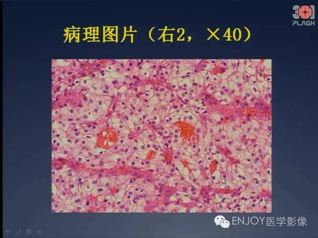 【病例】双肾透明细胞癌1例MR病例读片 【病例】双肾透明细胞癌1例MR病例读片