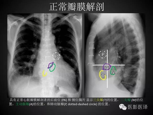 普通放射科医生需要了解的成人心脏瓣膜病知识 普通放射科医生需要了解的成人心脏瓣膜病知识