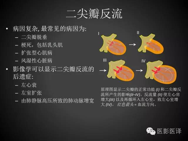 普通放射科医生需要了解的成人心脏瓣膜病知识 普通放射科医生需要了解的成人心脏瓣膜病知识