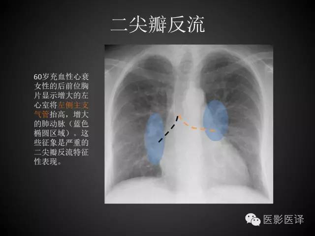普通放射科医生需要了解的成人心脏瓣膜病知识 普通放射科医生需要了解的成人心脏瓣膜病知识