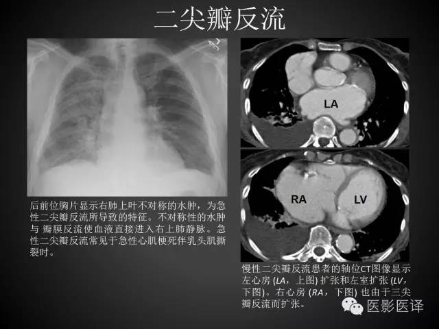 普通放射科医生需要了解的成人心脏瓣膜病知识 普通放射科医生需要了解的成人心脏瓣膜病知识