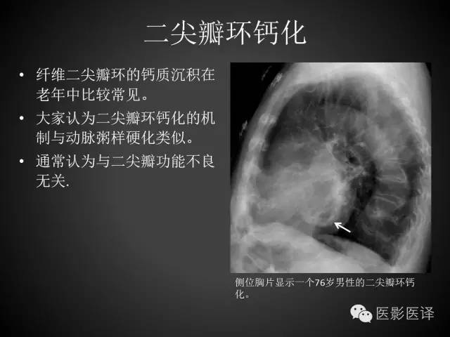 普通放射科医生需要了解的成人心脏瓣膜病知识 普通放射科医生需要了解的成人心脏瓣膜病知识