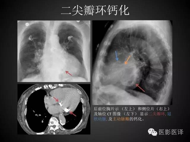 普通放射科医生需要了解的成人心脏瓣膜病知识 普通放射科医生需要了解的成人心脏瓣膜病知识