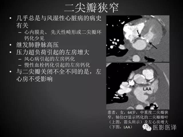 普通放射科医生需要了解的成人心脏瓣膜病知识 普通放射科医生需要了解的成人心脏瓣膜病知识