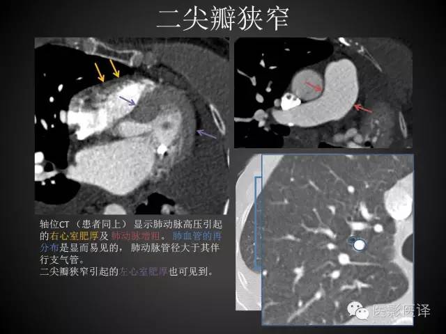 普通放射科医生需要了解的成人心脏瓣膜病知识 普通放射科医生需要了解的成人心脏瓣膜病知识