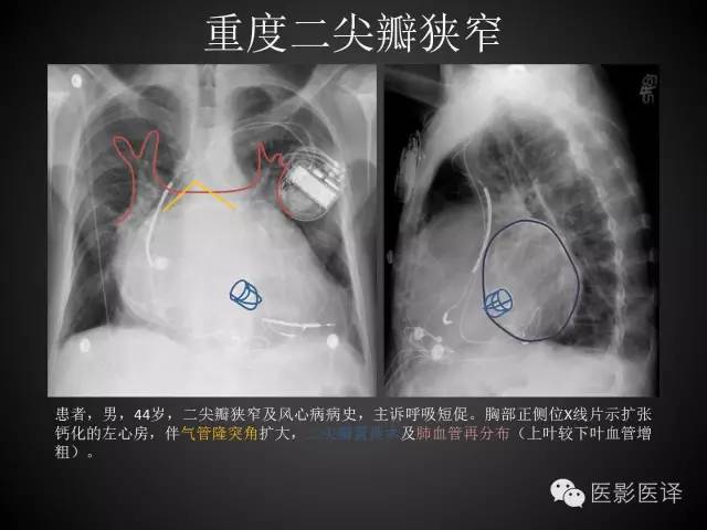 普通放射科医生需要了解的成人心脏瓣膜病知识 普通放射科医生需要了解的成人心脏瓣膜病知识