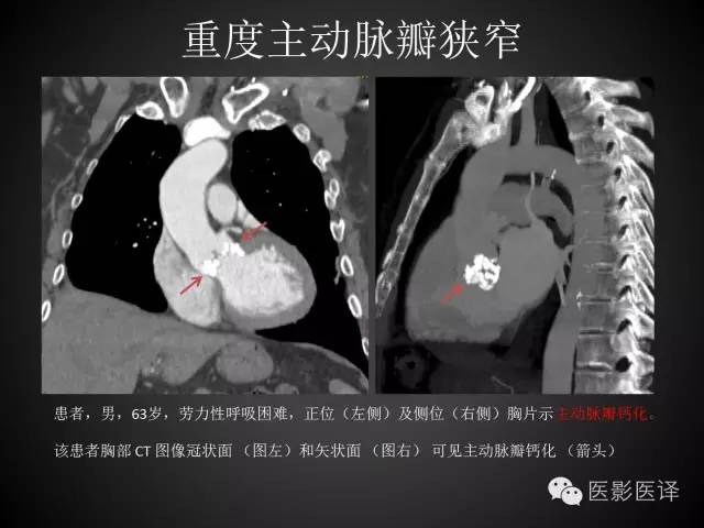 普通放射科医生需要了解的成人心脏瓣膜病知识 普通放射科医生需要了解的成人心脏瓣膜病知识