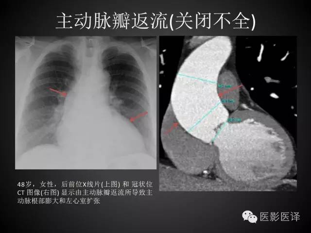 普通放射科医生需要了解的成人心脏瓣膜病知识 普通放射科医生需要了解的成人心脏瓣膜病知识