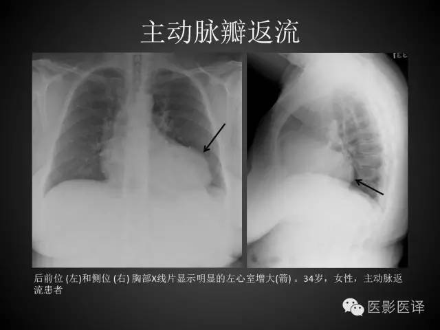 普通放射科医生需要了解的成人心脏瓣膜病知识 普通放射科医生需要了解的成人心脏瓣膜病知识