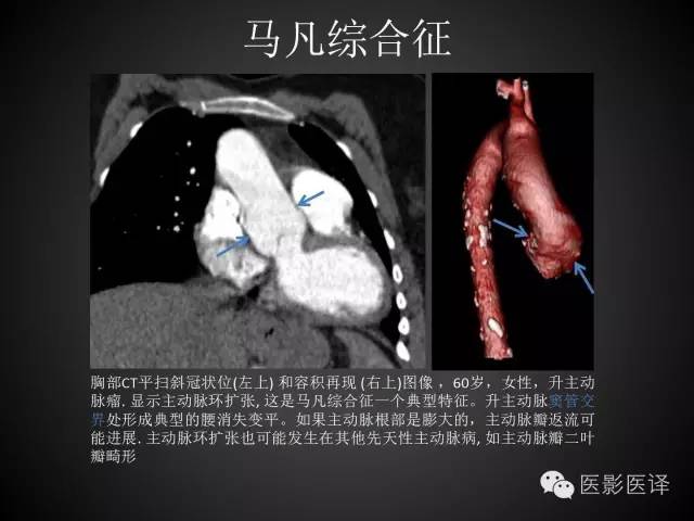 普通放射科医生需要了解的成人心脏瓣膜病知识 普通放射科医生需要了解的成人心脏瓣膜病知识