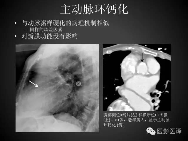 普通放射科医生需要了解的成人心脏瓣膜病知识 普通放射科医生需要了解的成人心脏瓣膜病知识