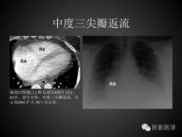 普通放射科医生需要了解的成人心脏瓣膜病知识 普通放射科医生需要了解的成人心脏瓣膜病知识
