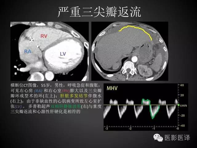 普通放射科医生需要了解的成人心脏瓣膜病知识 普通放射科医生需要了解的成人心脏瓣膜病知识