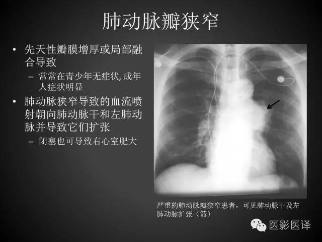 普通放射科医生需要了解的成人心脏瓣膜病知识 普通放射科医生需要了解的成人心脏瓣膜病知识