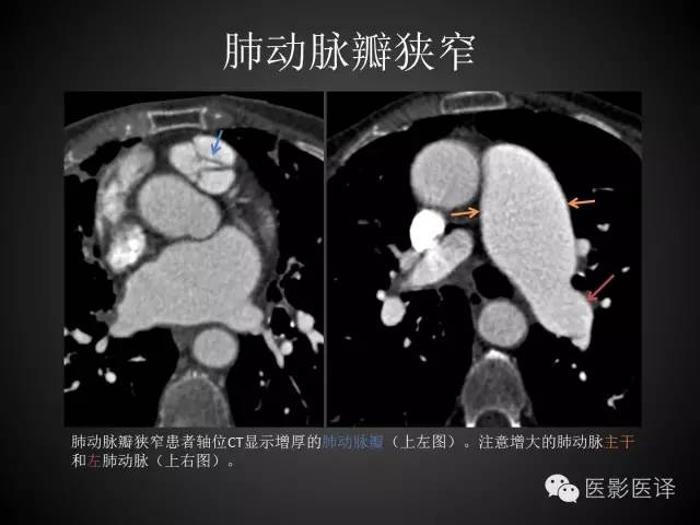 普通放射科医生需要了解的成人心脏瓣膜病知识 普通放射科医生需要了解的成人心脏瓣膜病知识