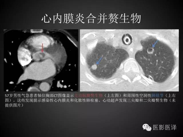 普通放射科医生需要了解的成人心脏瓣膜病知识 普通放射科医生需要了解的成人心脏瓣膜病知识